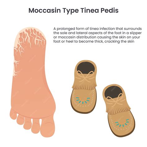 Premium Vector Moccasin Type Tinea Pedis Athletes Food Education