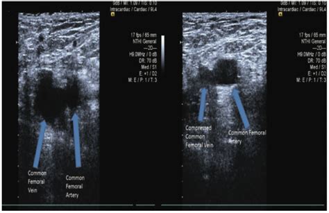 Ultrasound Guided Vascular Access Routes An Overview