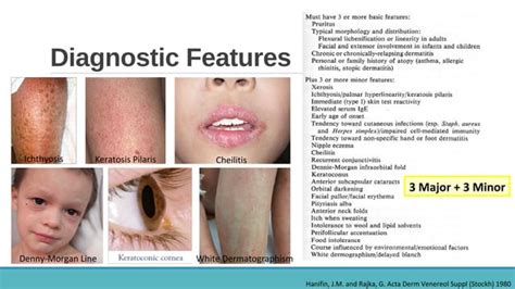 Atopic Dermatitis Ppt