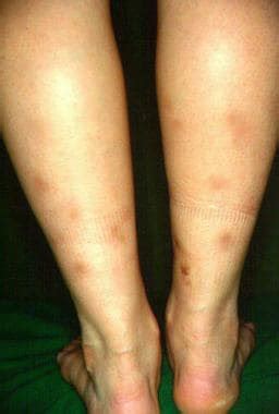 Erythema Induratum