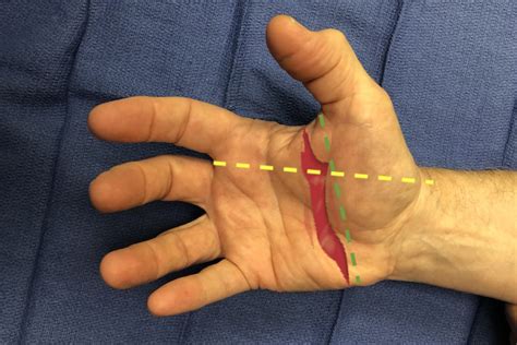 LACERATION (OPEN WOUND) | Hand Surgery Source