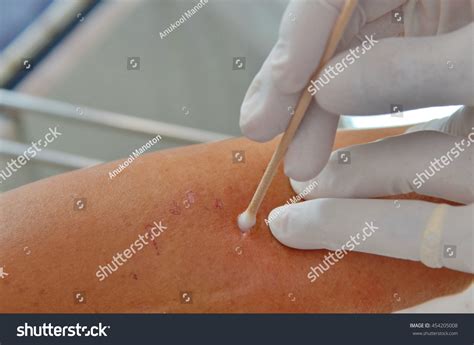 Dressing Dog Bite Wound. Stock Photo 454205008 : Shutterstock