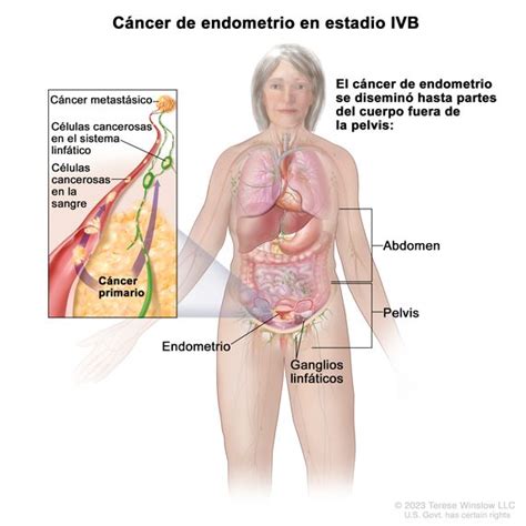 Definici N De C Ncer De Endometrio En Estadio Iv Diccionario De