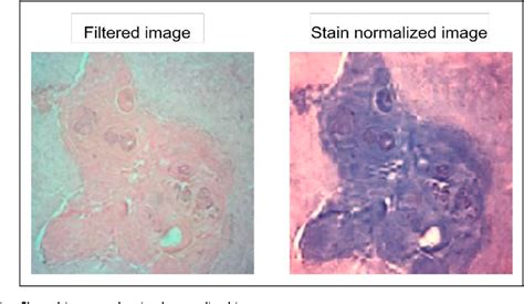 Figure 6 From Squamous Cell Carcinoma Of Skin Cancer Margin