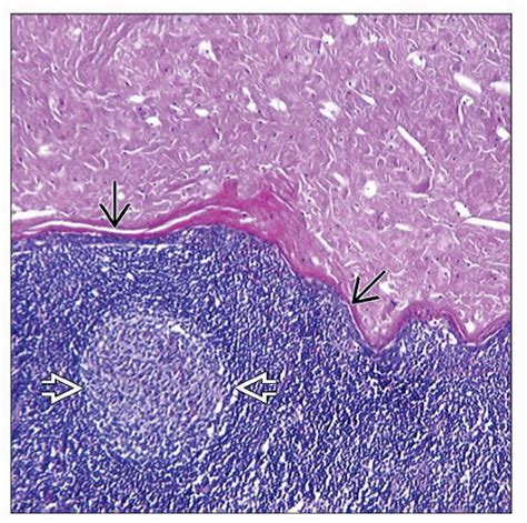 Branchial Cleft Cyst Histology