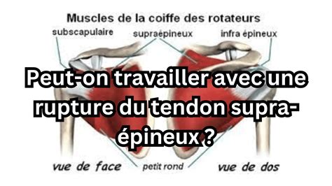 Peut on travailler avec une rupture du tendon supra épineux