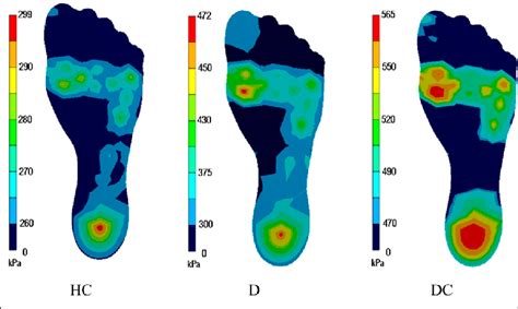 Plantar Pressure Distribution Across The Hc D And Dc Group