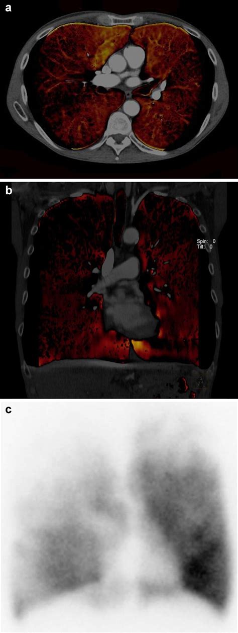 Pulmonary Dual Energy Ct Angiography Allows Assessment Of Lung