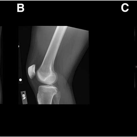 Preoperative Radiographic Films A B An Anteroposterior