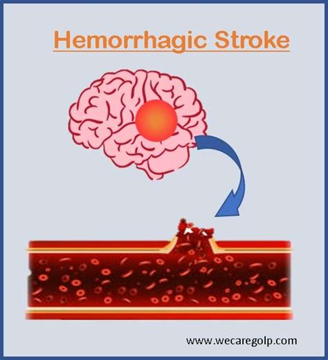 Stroke Types Symptoms Treatment Complications We Care