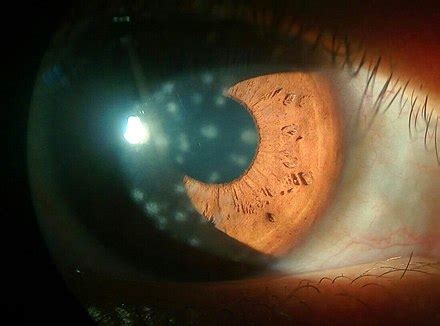 Keratitis - Wikipedia