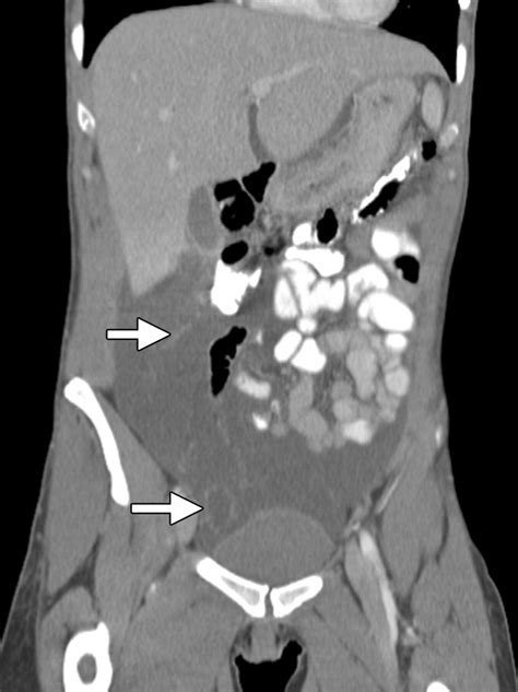 Case 146 Benign Multicystic Mesothelioma Radiology