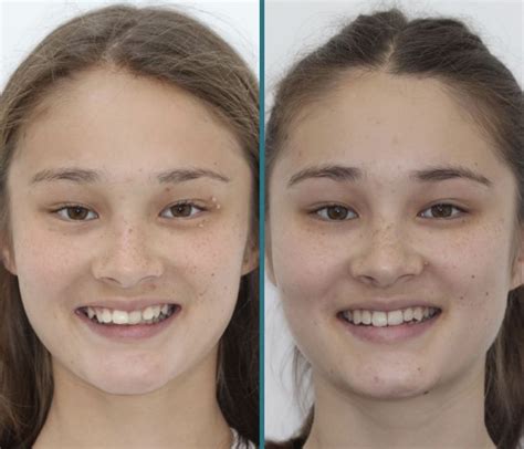 Overbite Before And After Pictures