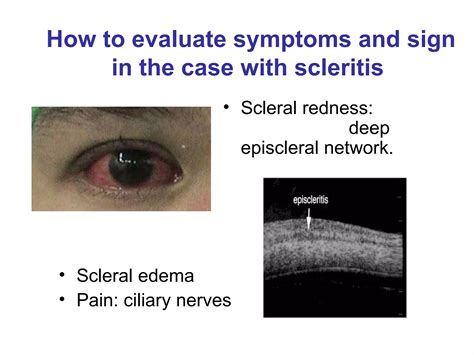 Scleritis Professor 1001030 Ppt