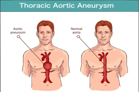 Aortic Aneurysm Surgery - FactDr