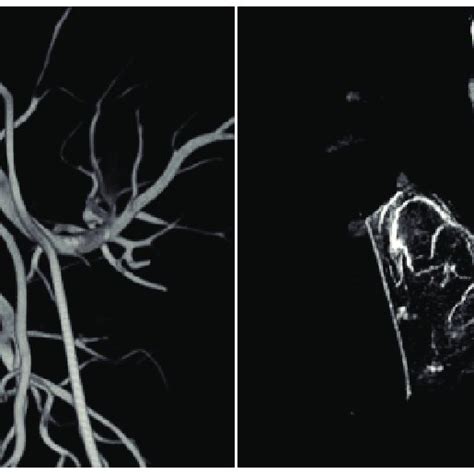 Non Selective Cone Beam CT Angiography Was Performed Left Image A