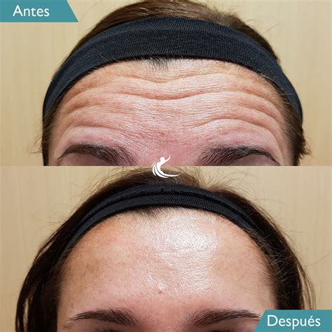 Lista 91 Foto Botox Para Bruxismo Antes Y Despues Actualizar