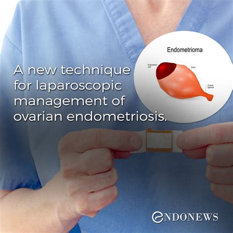 A New Technique For Laparoscopic Management Of Ovarian Endometriosis