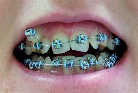 Traditional braces may wear for achieve cosmetic objectives and solves ...