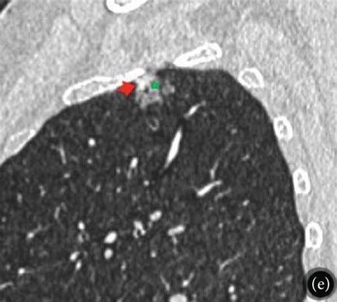 The Ct Images Of A Year Old Female Patient With Adenocarcinoma