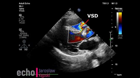 Ventricular Septal Defect Vsd Echocardiography Echo Congenital Heart