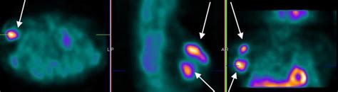 Spect With M Tc Mibi For The Patient With Secondary Infiltrative