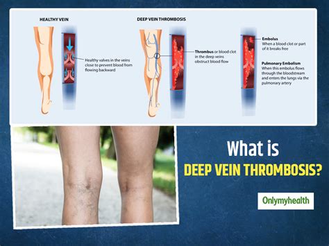 Deep Vein Thrombosis, DVT Symptoms, Causes And, 57% OFF