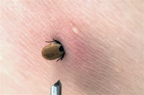 How To Identify Tick Bites Tick Bite Pictures IGeneX Tick Talk