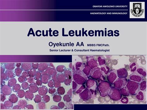 Ppt Acute Leukemias Powerpoint Presentation Free Download Id 3841754