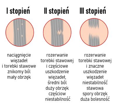 Skręcenie a zwichnięcie kostki na czym polega różnica