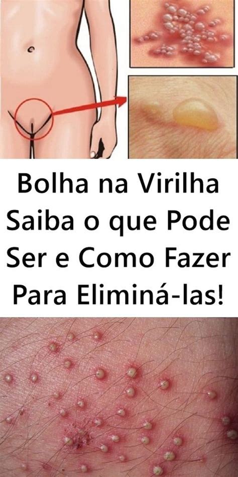 Bolha Na Virilha Saiba O Que Pode Ser E Como Fazer Para Elimin Las