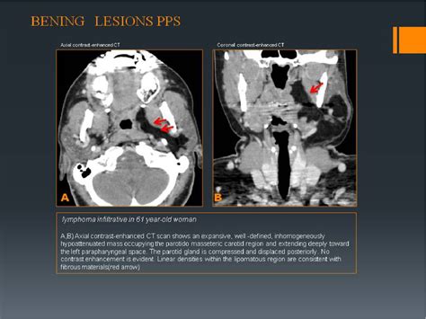 The parapharyngeal space: Review of the anatomy and pathologic ...