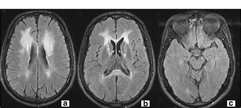 Figure 1 From Adult Onset Leukodystrophy With Axonal Spheroids