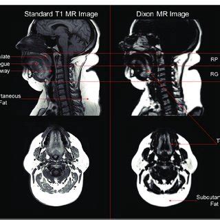 Comparison Of Tongue Fat Using Standard T1 Weighted Spin Echo MR