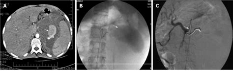 Splenic Artery Pseudoaneurysm Before And After Embolization A Post