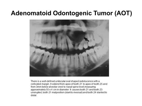 Adenomatoid Odontogenic Tumor