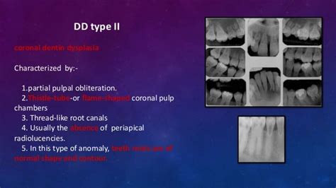 Dentin Dysplasia Types