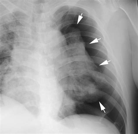 Chest Radiographic Images Of The Pneumothorax Chest Radiograph