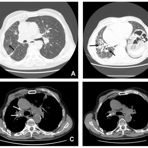 Ct Findings In Pulmonary Sarcoidosis Panel A Large Nodule Surrounded Download Scientific