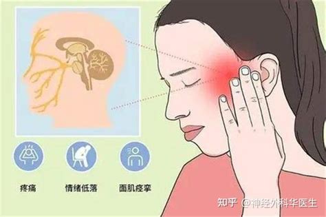 四个有效预防三叉神经痛的措施 知乎