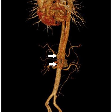 Computed tomography showing an infrarenal AAA with a sharp angled neck ...