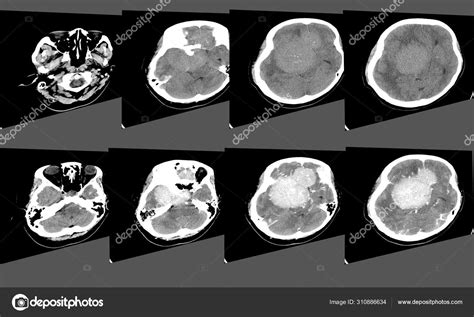 Ct Scan Brain Axial Scans With Mm Slice Thickness From Om Line To