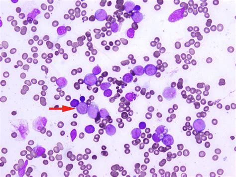 Blast Cells On Bone Marrow Biopsy Immature Looking Cells Arrow Much