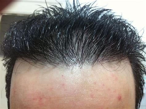 best hair transplant near me - Bad Way Online Diary Photo Galery