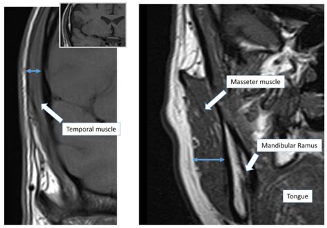 Temporal And Masseter Muscle Evaluation By Mri Provides Information On Muscle Mass And Quality