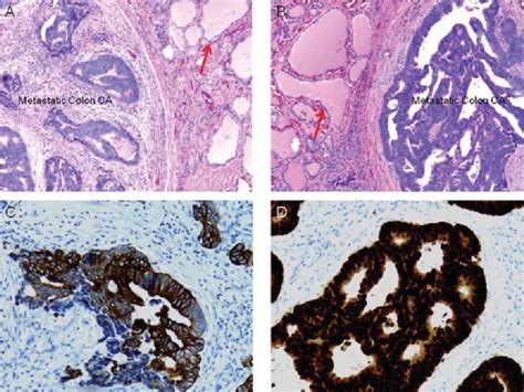 Histological And Immunophenotypical Examination Of The Resected