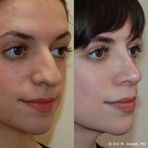 Eric M Joseph Md Primary Rhinoplasty Gallery