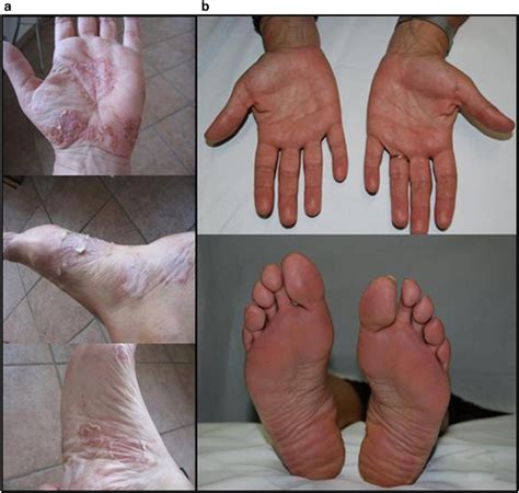 Palmo Plantar Psoriasis At Diagnosis B Clearance Of The Skin Lesions