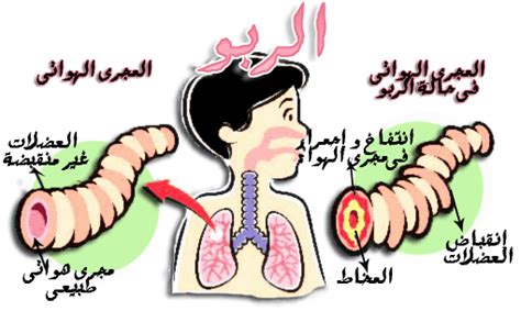 ملف شامل عن مرض الربو حساسية الصدر