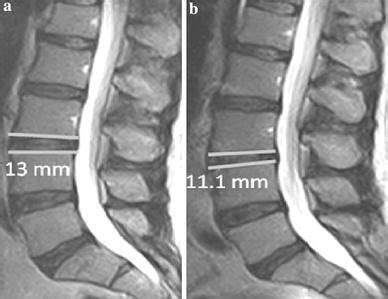 Fast Spin Echo Fse T Weighted Magnetic Resonance Images Mri In The